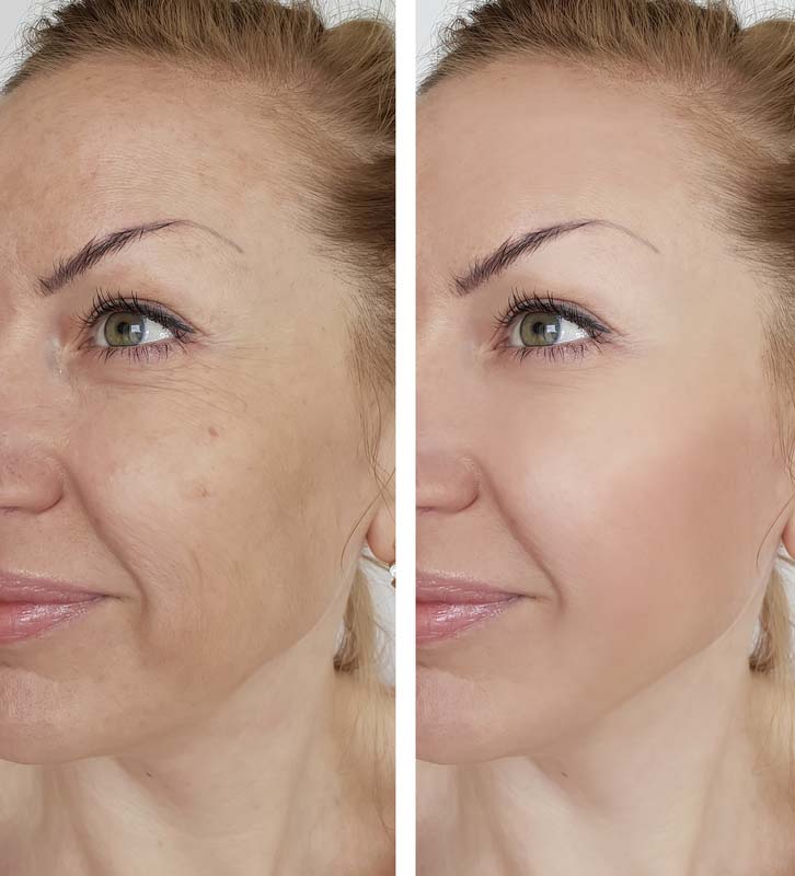 Facial Face girl wrinkle before and after cosmetic procedures correction effect lifting